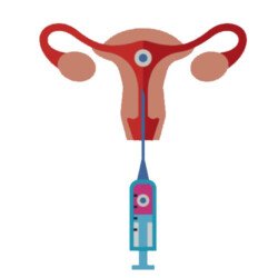 Elective Single Blastocyst Transfer