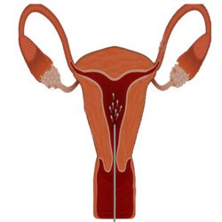 Intrauterine Insemination