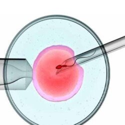 Intracytoplasmic Sperm Injection (ICSI)